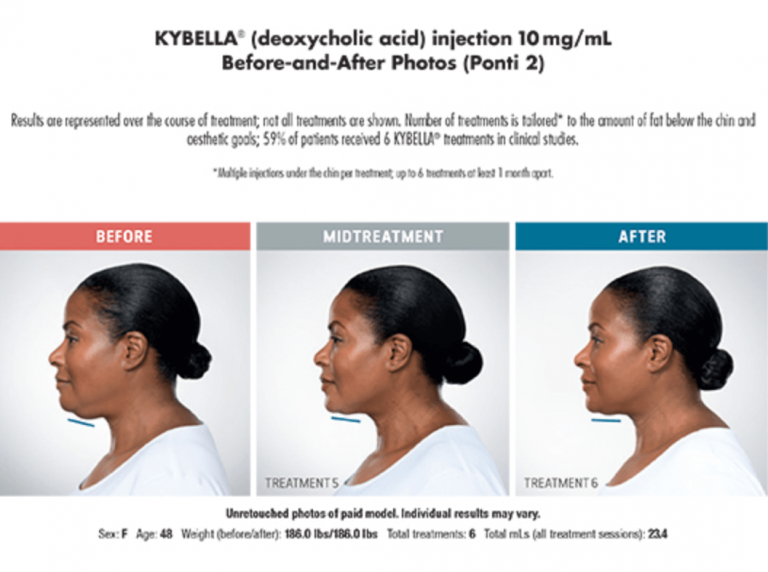 Seattle Kybella Services - Blue Haven Medical Spa Green Lake